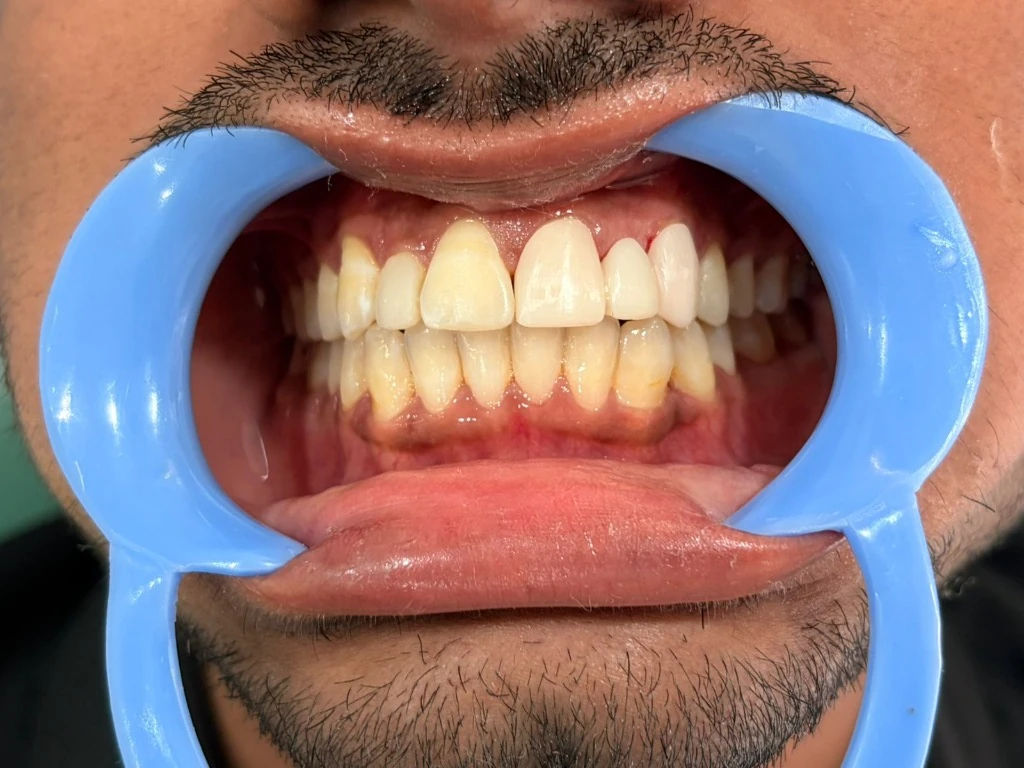 After treatment: Tooth replacement with metal-free bridge at Kedia Dental Care