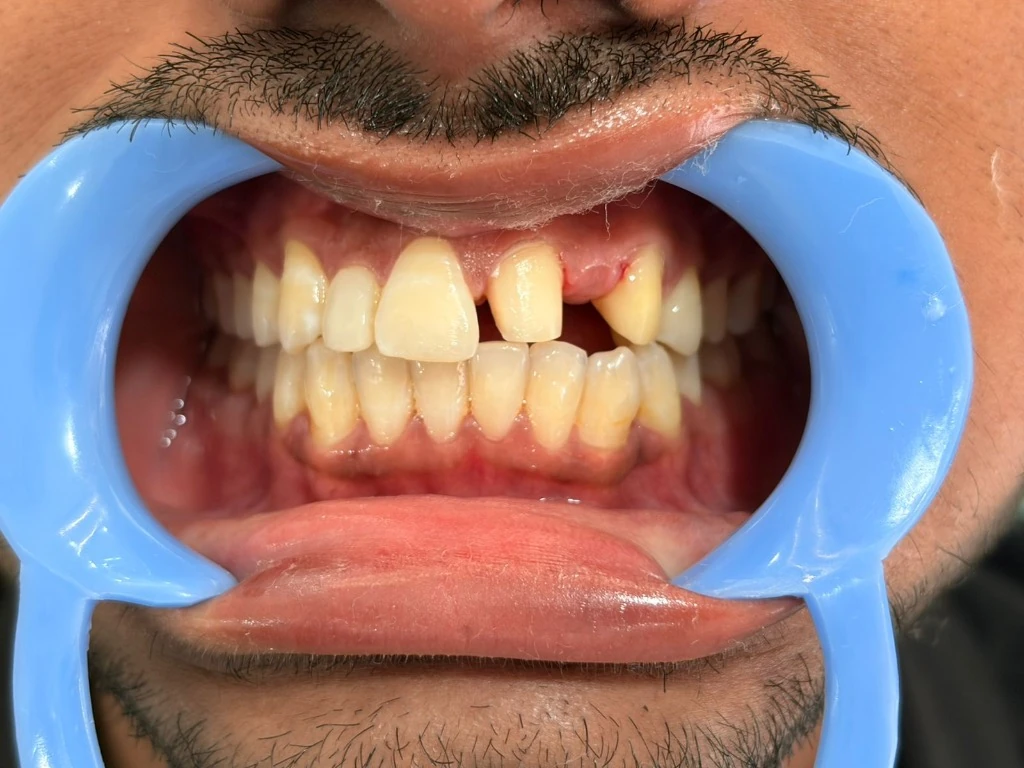 Before treatment: Missing tooth space and prepared anchor teeth at Kedia Dental Care